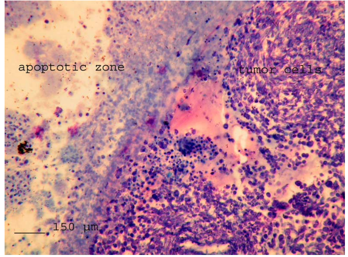 Nécrose tumorale glioblastome Rat